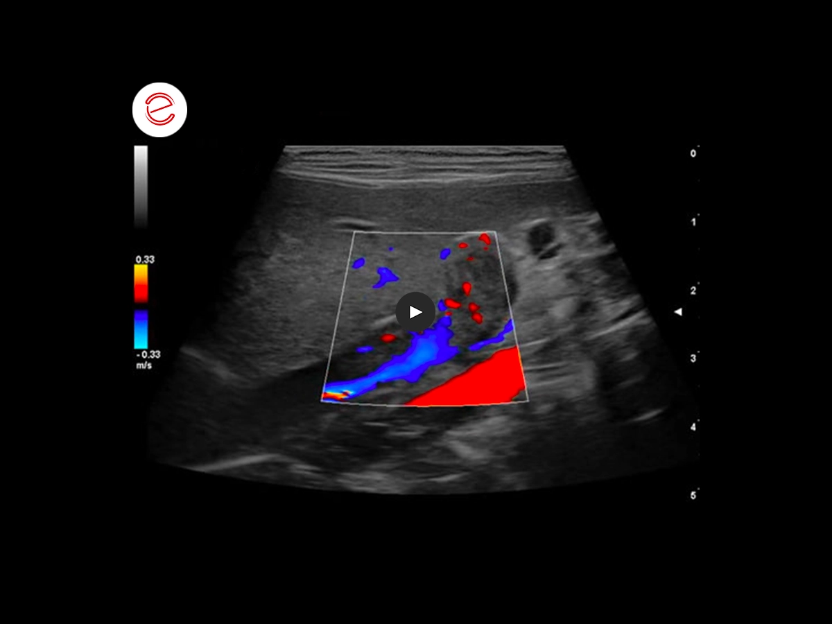 Adrenal adenoma 3