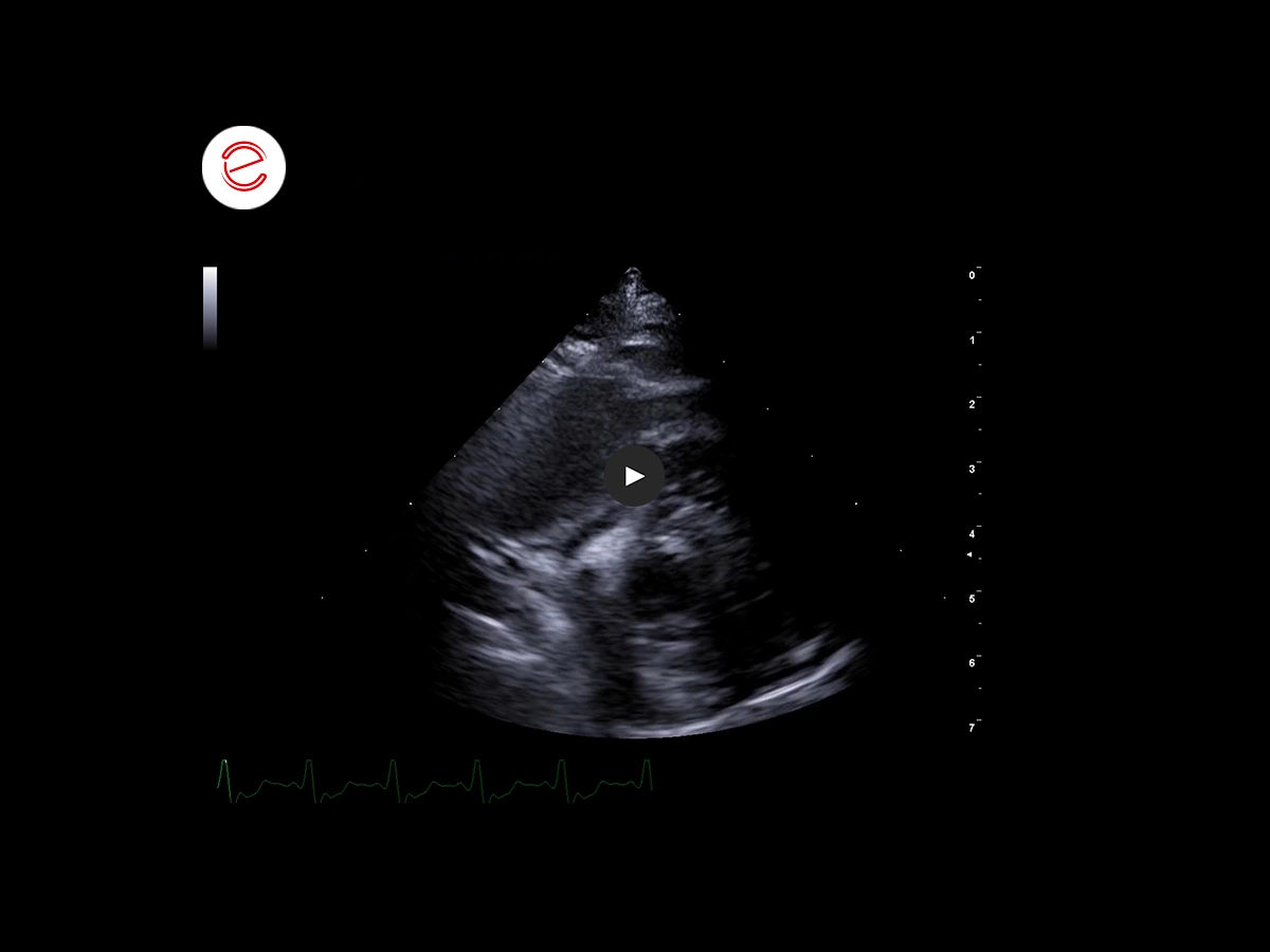 Right atrial Hemangiosarcoma 2