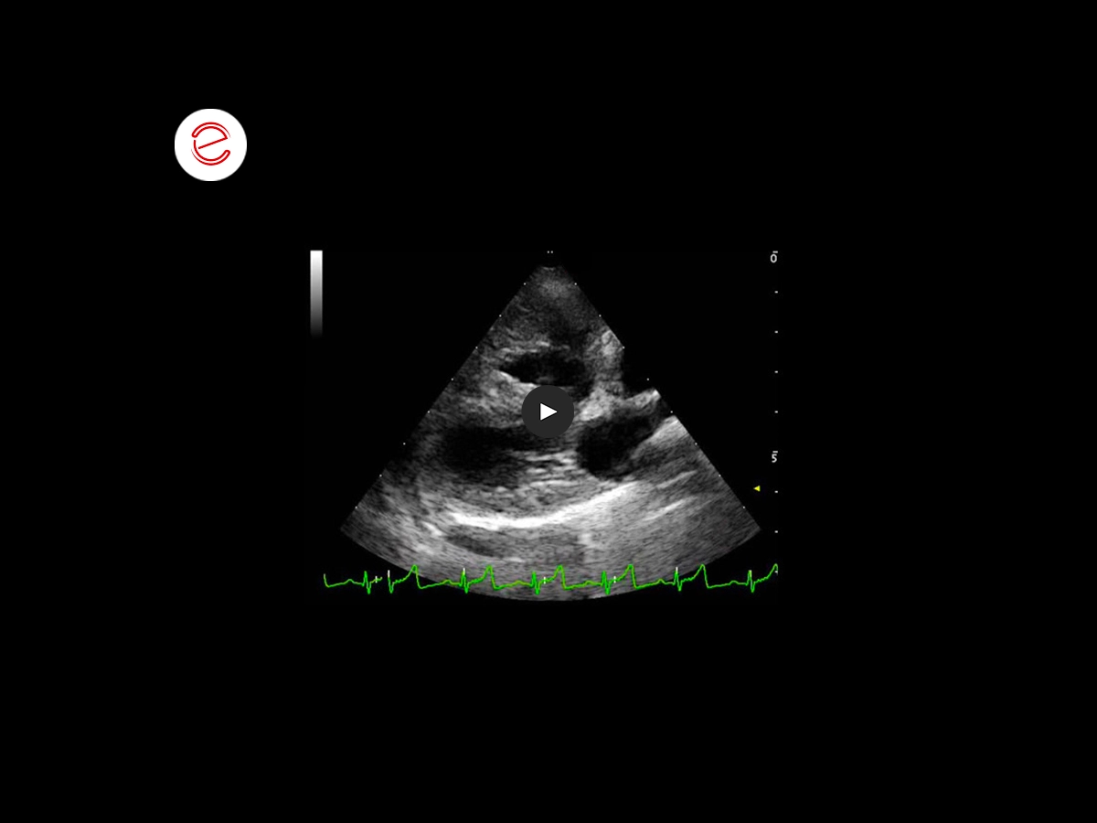 Tetralogy of fallot 2