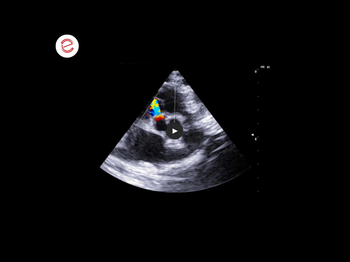 Ventricular septum defect 2