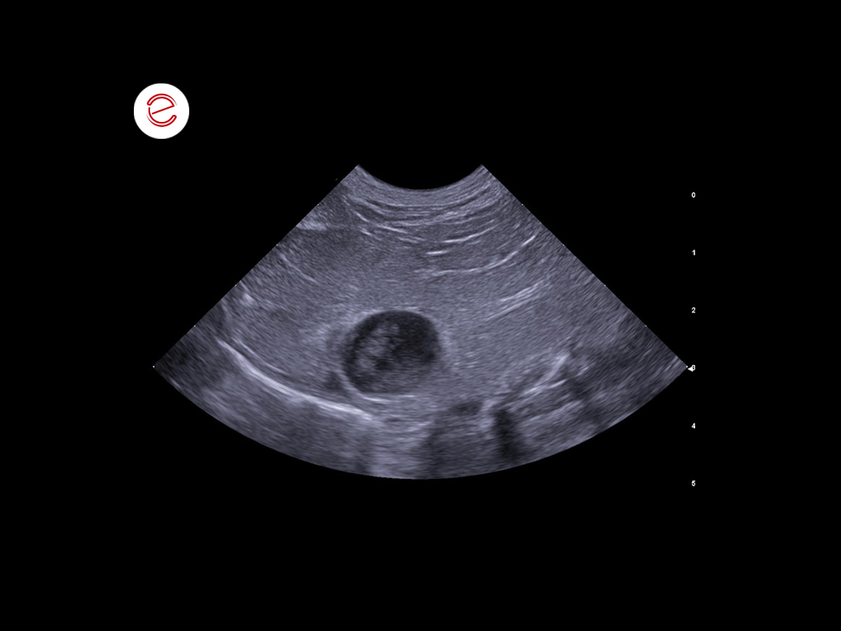 abdominal ultrasound with microconvex (Freq 3-11 MHz) and linear (Freq 4-15 MHz) probes, organ’s  normal echostructure