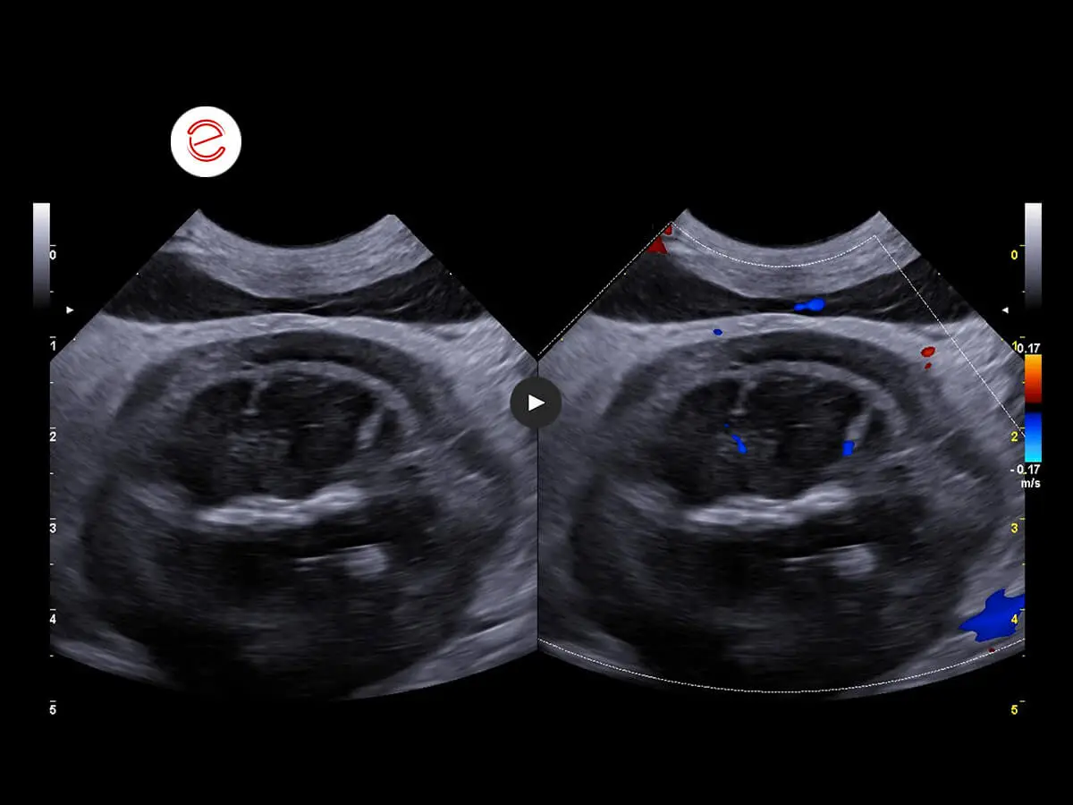 Vascularization of the right kidney preserved.