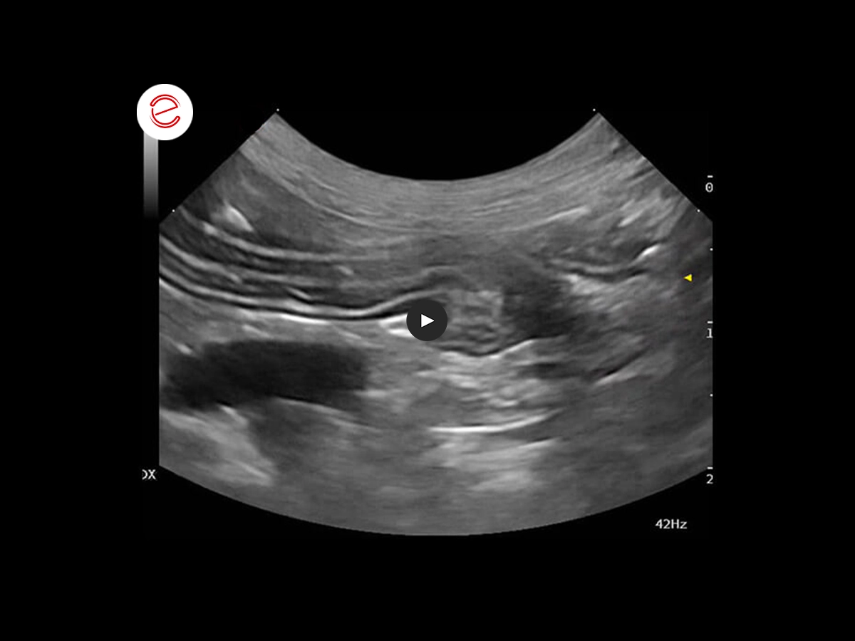 Abnormality of the small intestine