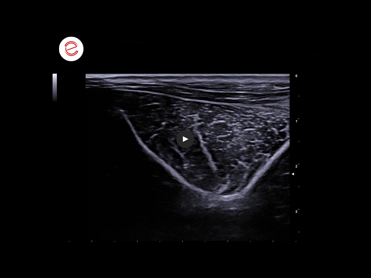 Brachial biceps rupture 1