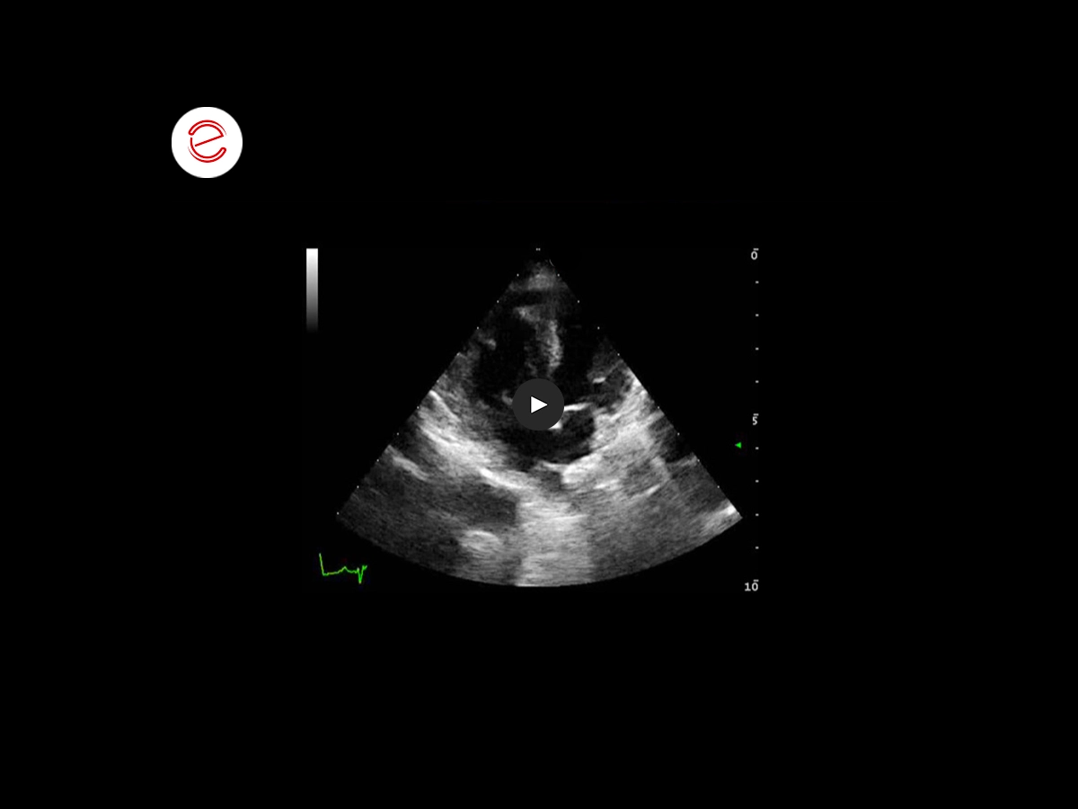 Tetralogy of fallot 6