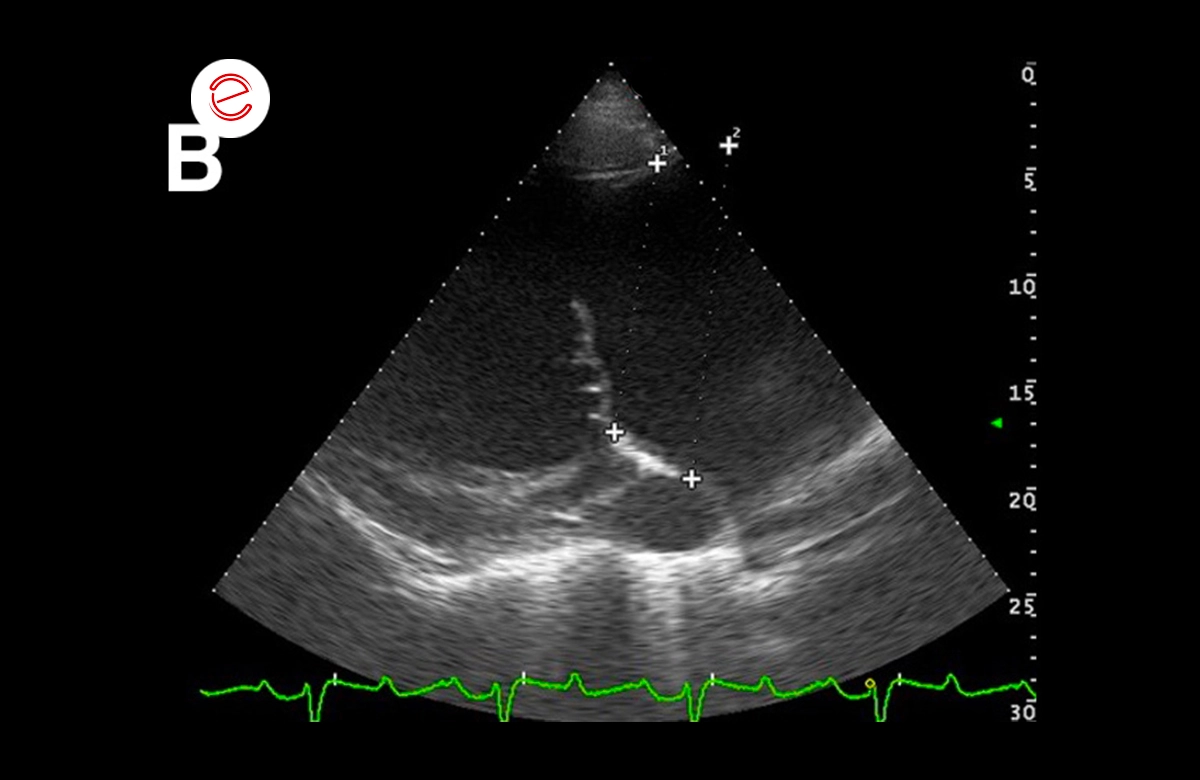 Left parasternal view of the left atrium and ventricle