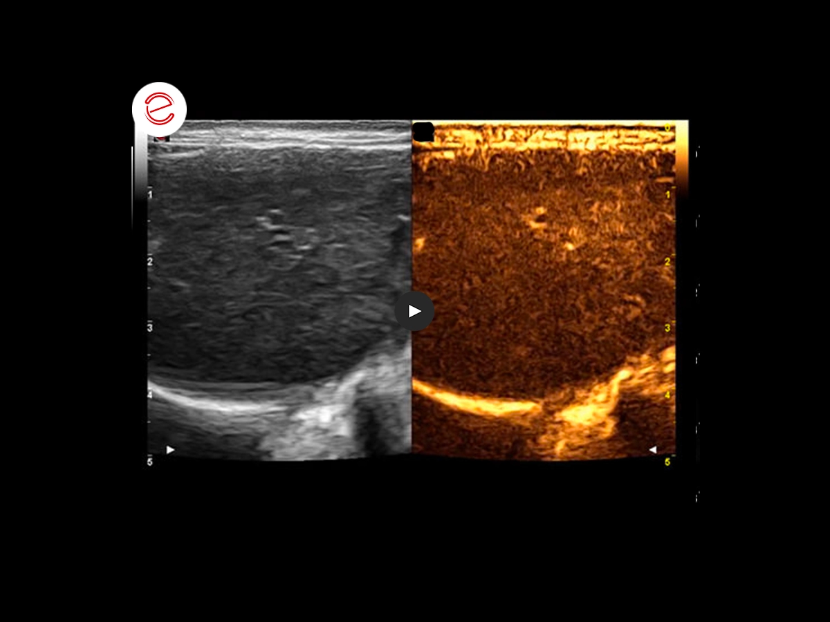 Adrenal adenoma 6