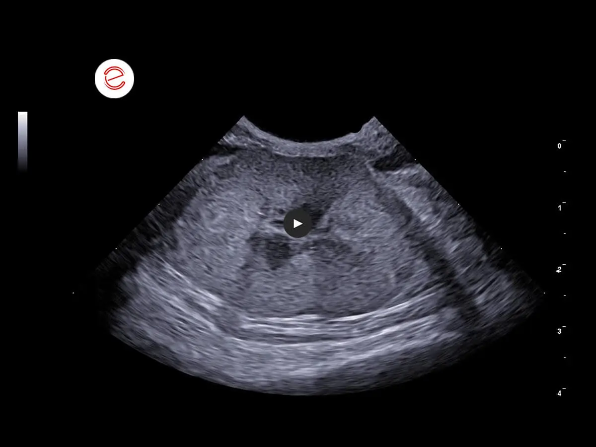 Left kidney: normal size, regular margins, cortical hyperechogenicity, loss of cortico-medullary distinction.