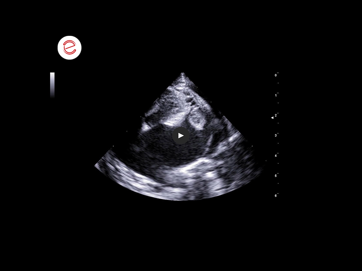 Restrictive cardiomyopathy 7