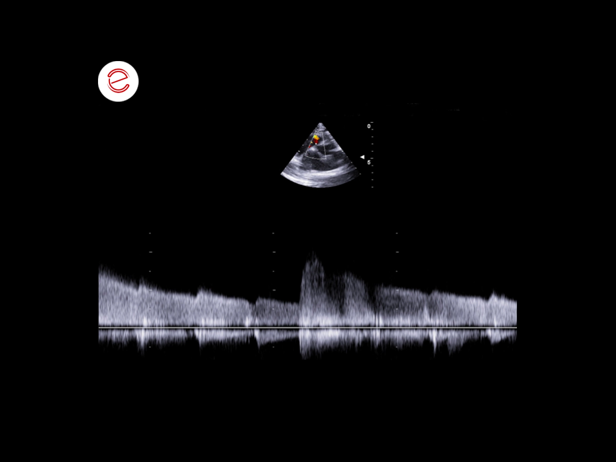 Systolic flow through the VSD, with left-to-right shunt, measured by continuous-wave Doppler