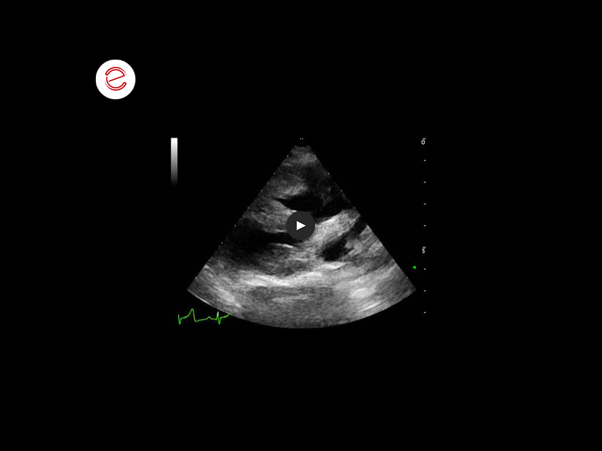 Tetralogy of fallot 3