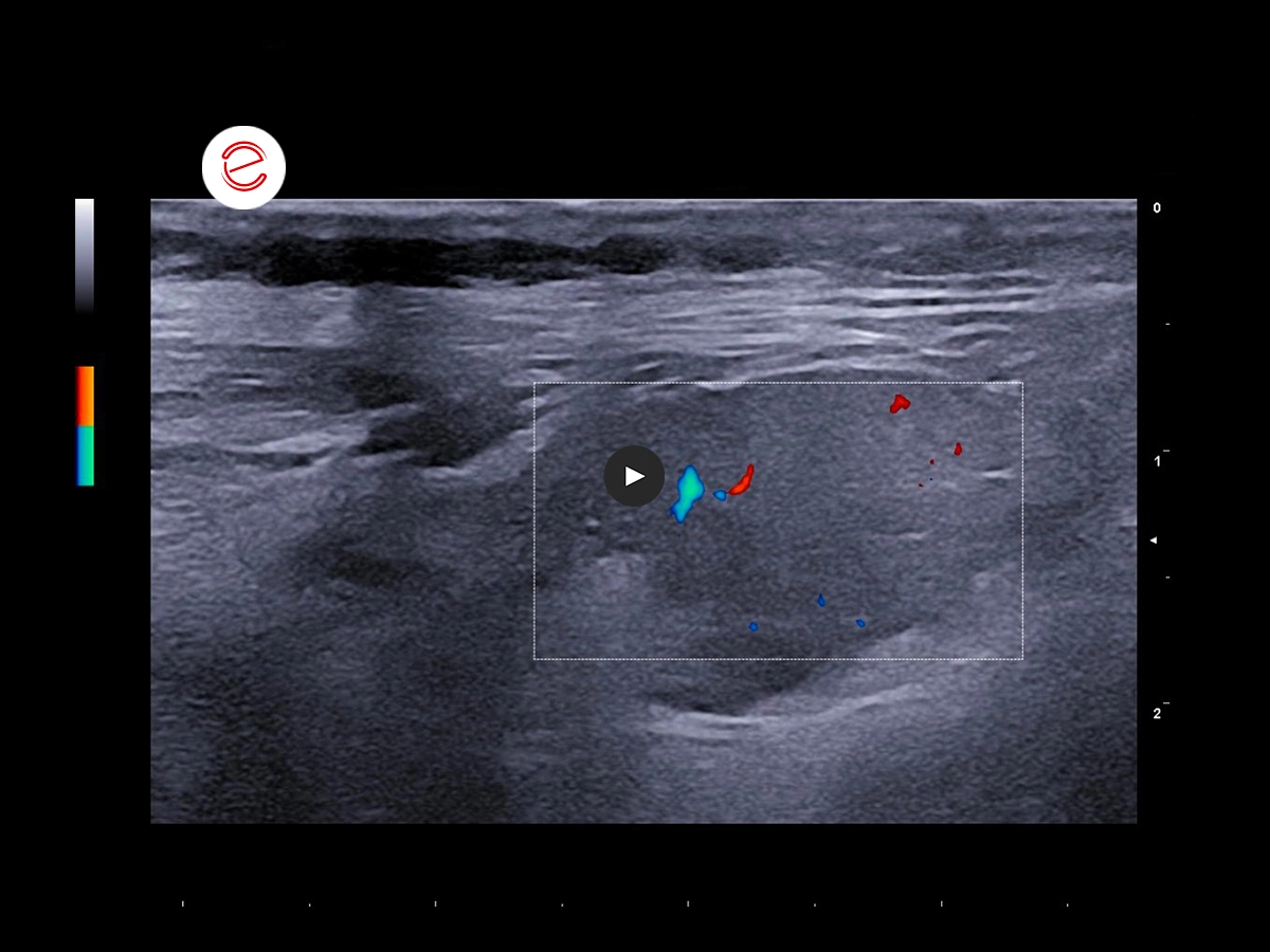 Synovial Sarcoma 5