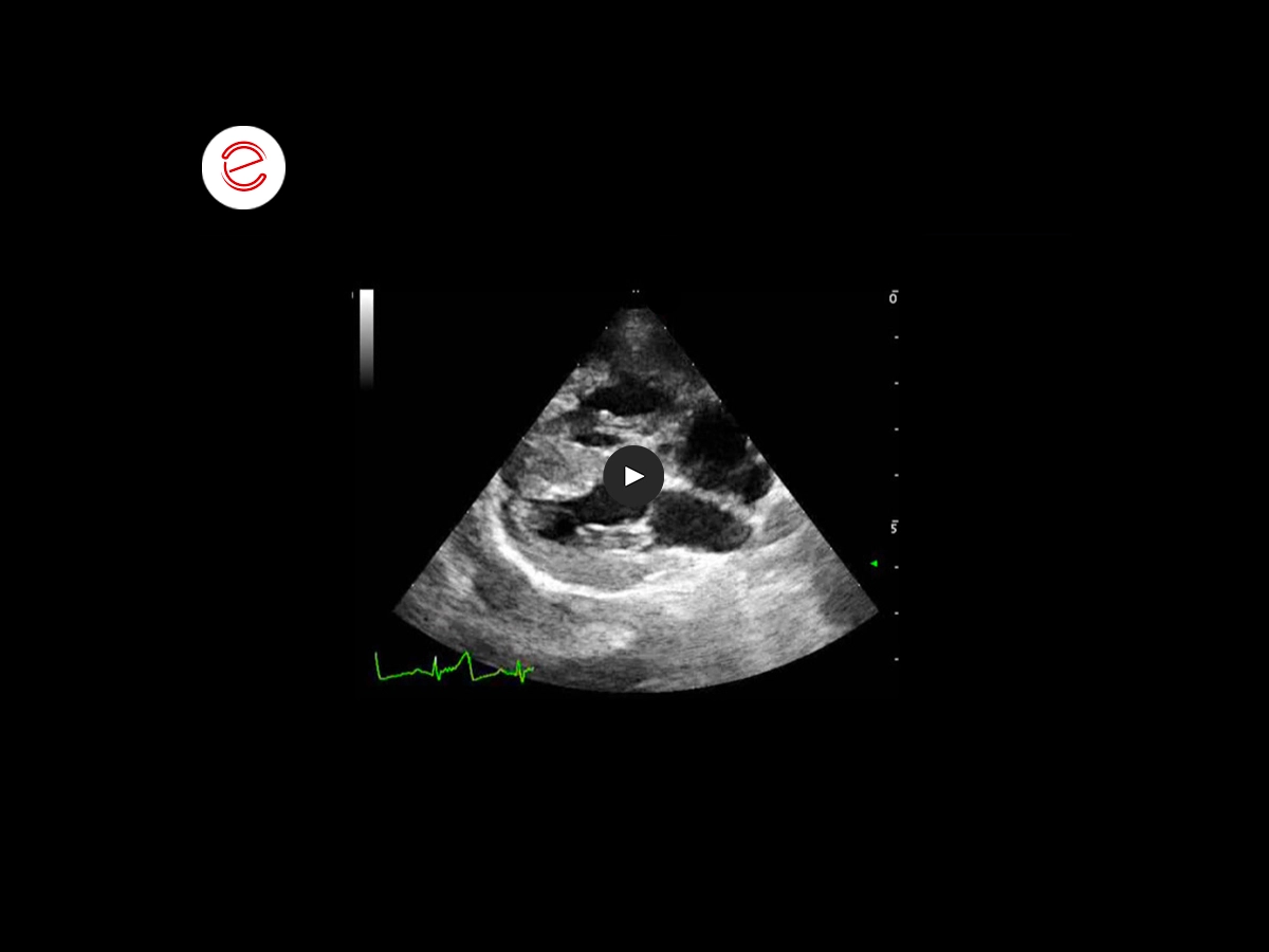 Tetralogy of fallot 1