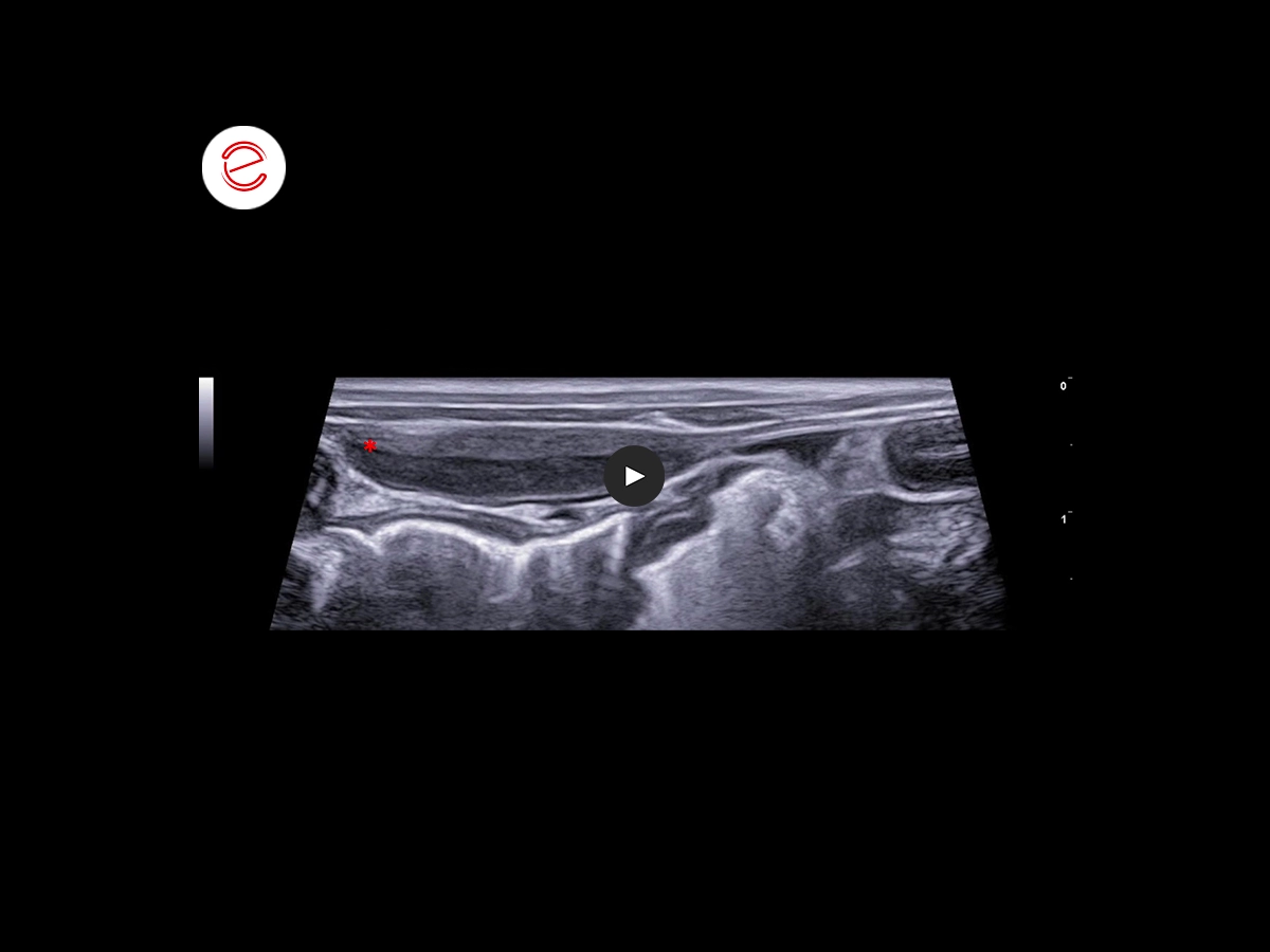 Corneal ulcer 8