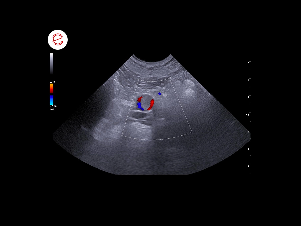 Aorta in transverse section