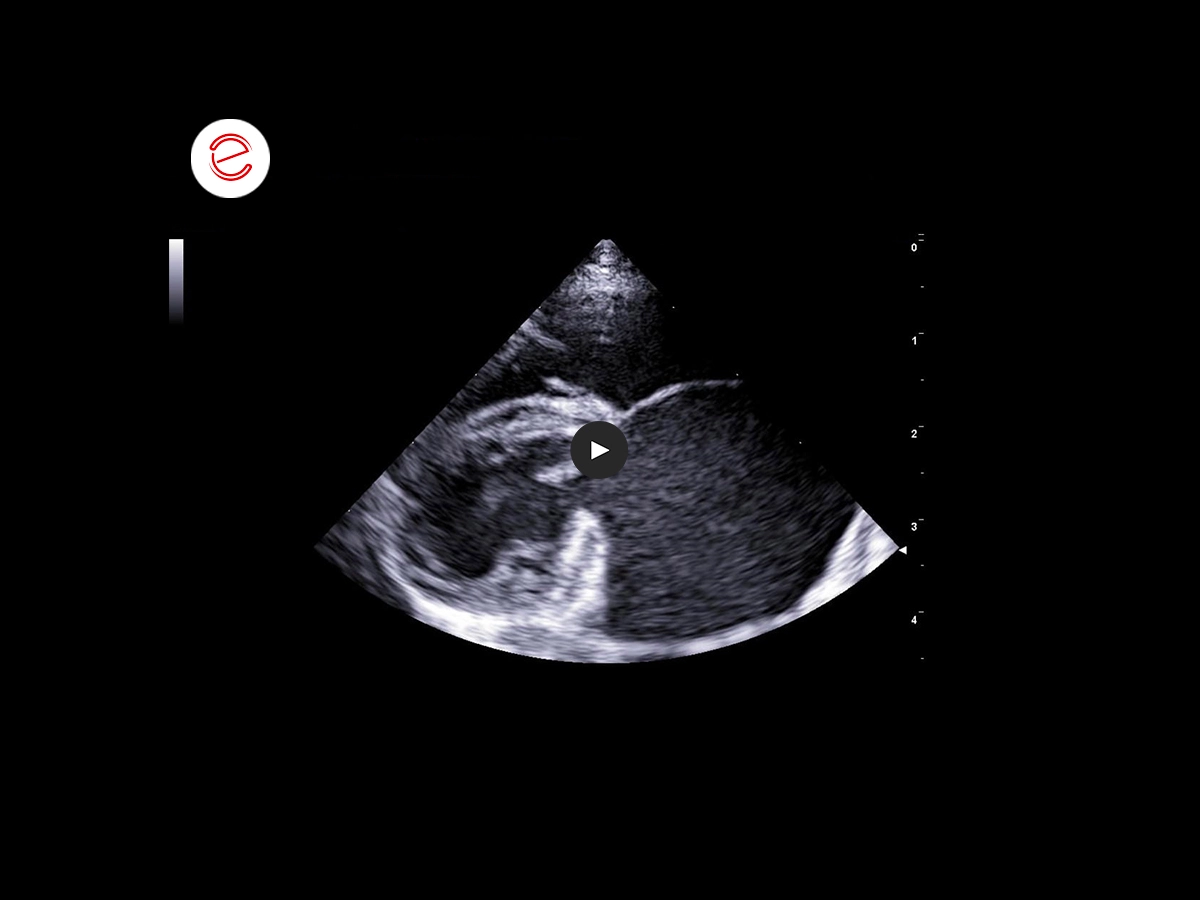 Restrictive cardiomyopathy 1