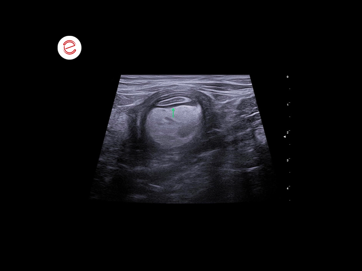 Ileocolic intestinal intussusception 2