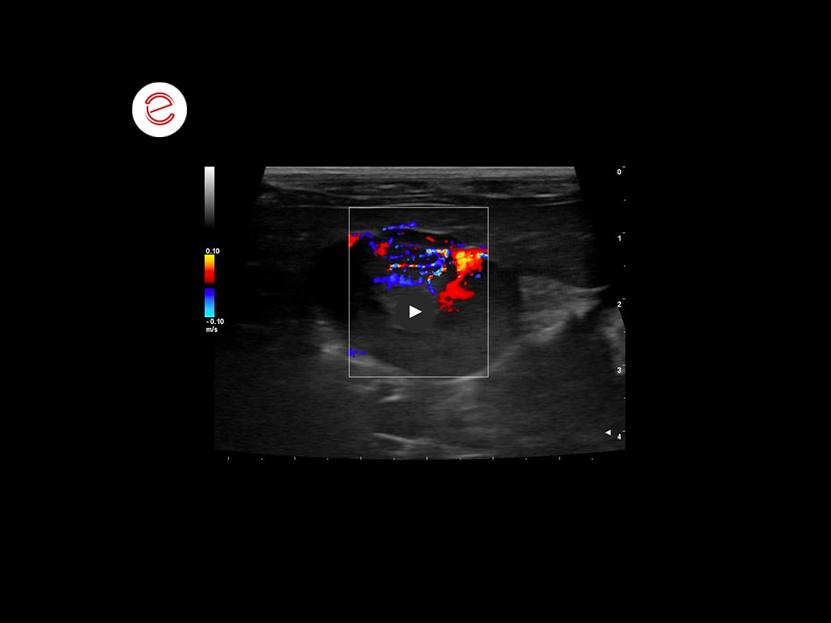 Gallbladder neuroendocrine neoplasm 3