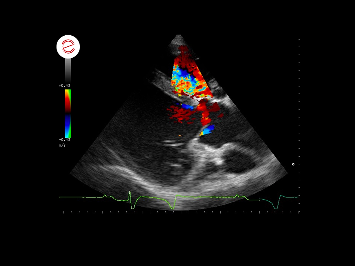 Systolic flow shunt from the left to the right ventricle by means of Color flow Doppler