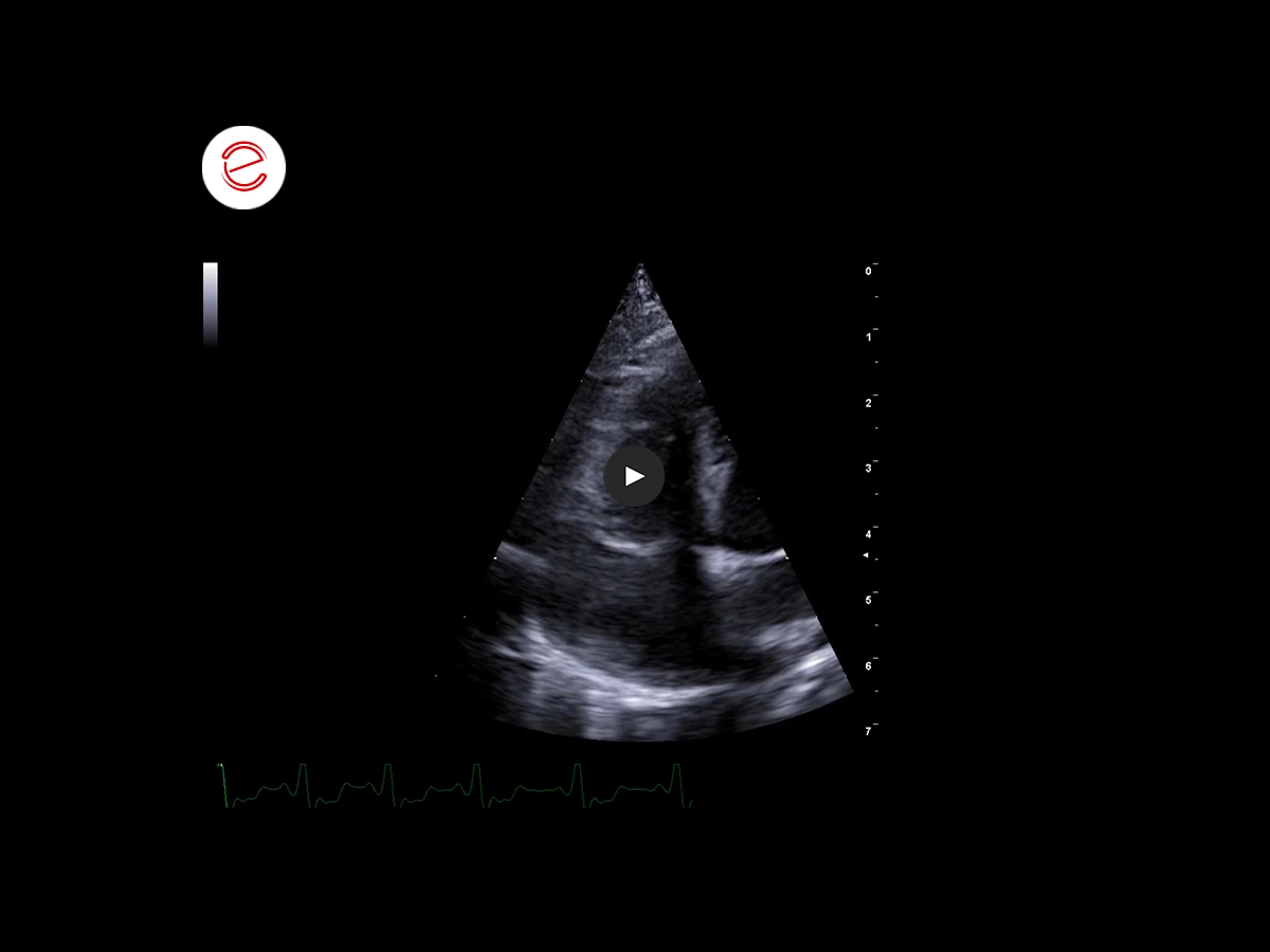 Right atrial Hemangiosarcoma 3