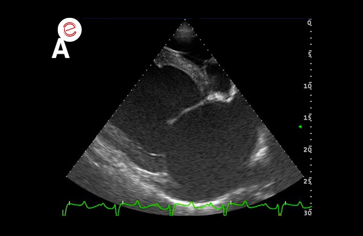 Right parasternal 4 chamber view and left parasternal view of the left atrium and ventricle