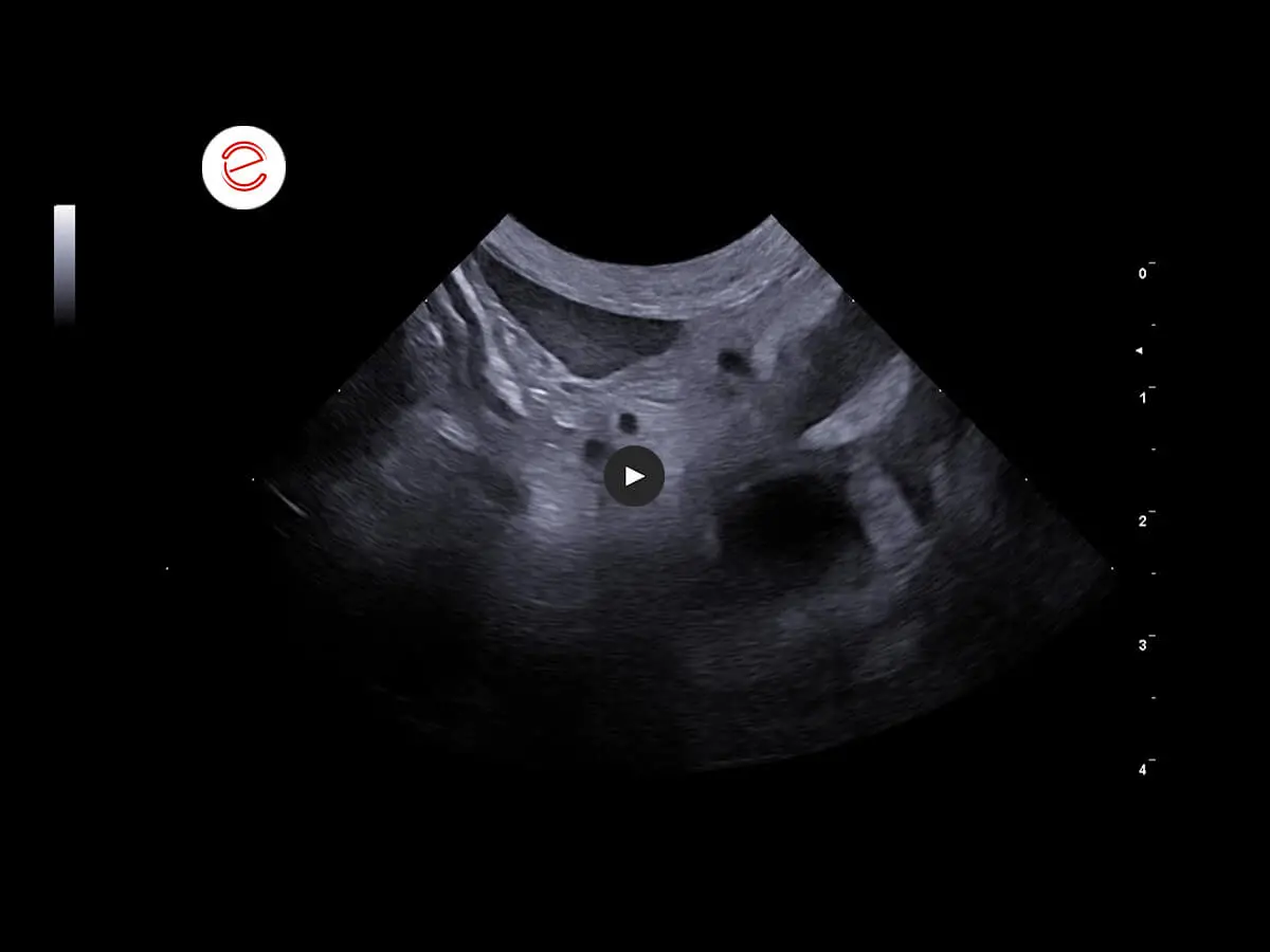 Diffuse omental hyperechogenicity associated with findings of layers of abdominal effusion with an anechoic appearance.